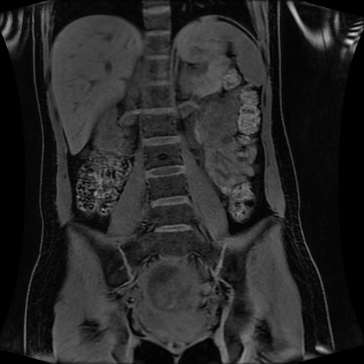Normal MRI abdomen in pregnancy (Radiopaedia 88001-104541 M 87).jpg