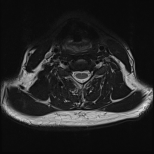 File:Normal MRI cervical spine (infection protocol) (Radiopaedia 53916-60039 Axial T2 31).png