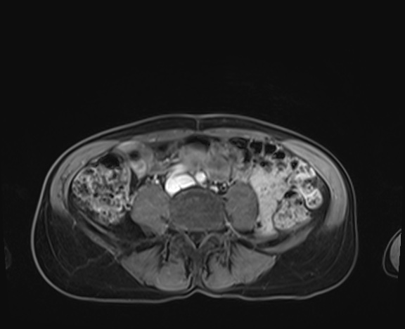 Normal adrenal glands MRI (Radiopaedia 82017-96004 K 70).jpg