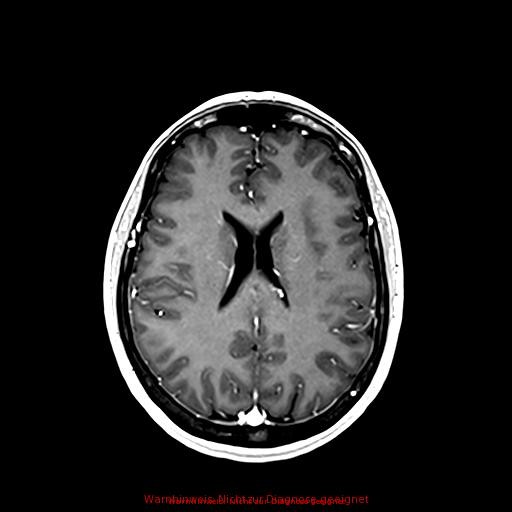 Normal adult brain MRI (non-enhanced and contrast-enhanced) (Radiopaedia 75262-86379 Axial T1 C+ 121).jpg