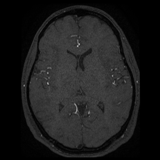 Normal brain MRA (Radiopaedia 41046-43793 Axial MRA 19).png