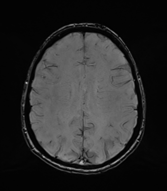Normal brain MRI (TLE protocol) (Radiopaedia 40748-43405 Axial SWI 59).png