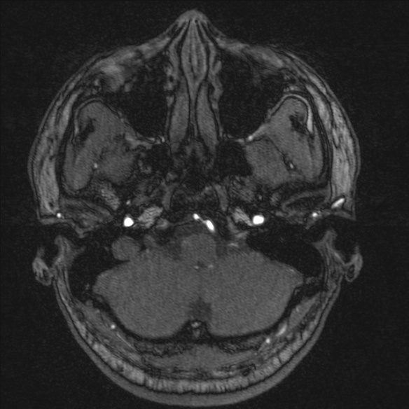 Normal brain MRI including MRA (Radiopaedia 48748-53763 Axial MRA 27).jpg