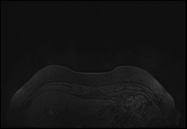 File:Normal breast MRI - dense breasts (Radiopaedia 80454-93850 Axial T1 4).jpg