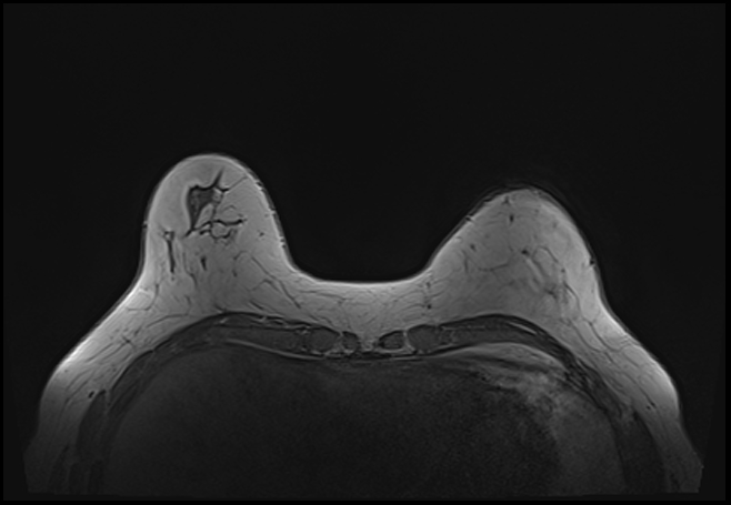 File:Normal breast MRI - dense breasts (Radiopaedia 80454-93850 Axial T1 47).jpg