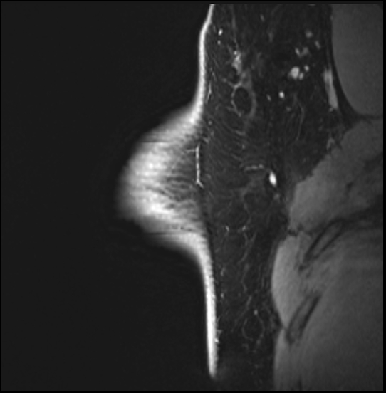 Normal breast MRI - dense breasts (Radiopaedia 80454-93850 I 42).jpg