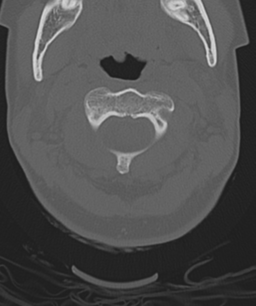 Normal cervical spine MRI (including Dixon) (Radiopaedia 42762-45926 Axial bone window 16).png