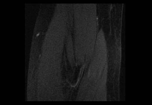 File:Normal elbow arthrograms (Radiopaedia 75550-86805 Coronal T1 fat sat 13).jpg