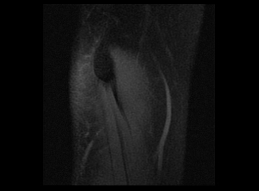 File:Normal elbow arthrograms (Radiopaedia 75550-86805 Sagittal T1 fat sat 16).jpg