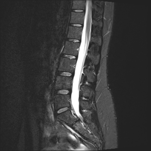 File:Normal lumbar spine MRI- 3 T (Radiopaedia 53280-59250 Sagittal STIR 14).jpg