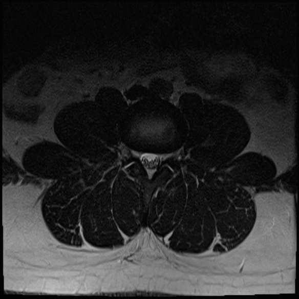 File:Normal lumbar spine MRI (Radiopaedia 47857-52609 Axial T2 7).jpg