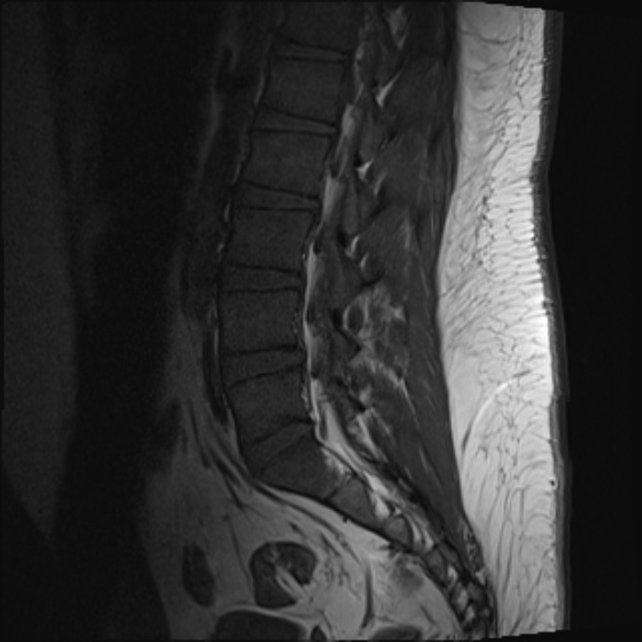 File:Normal lumbar spine MRI (Radiopaedia 47857-52609 Sagittal T1 12).jpg