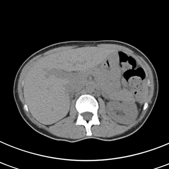 File:Normal multiphase CT liver (Radiopaedia 38026-39996 Axial non-contrast 22).jpg