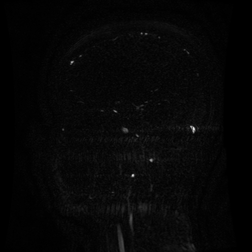 Normal noncontrast MR venography (Radiopaedia 87578-103957 A 108).jpg