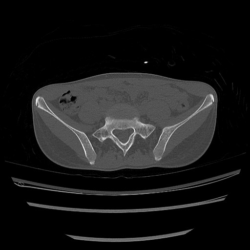 Normal pelvis CT (Radiopaedia 51471-57236 Axial bone window 20).jpg
