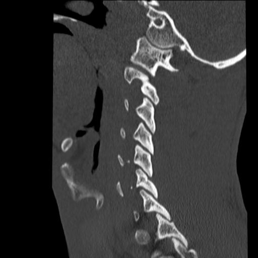 File:Normal trauma cervical spine (Radiopaedia 41017-43760 Sagittal bone window 10).png