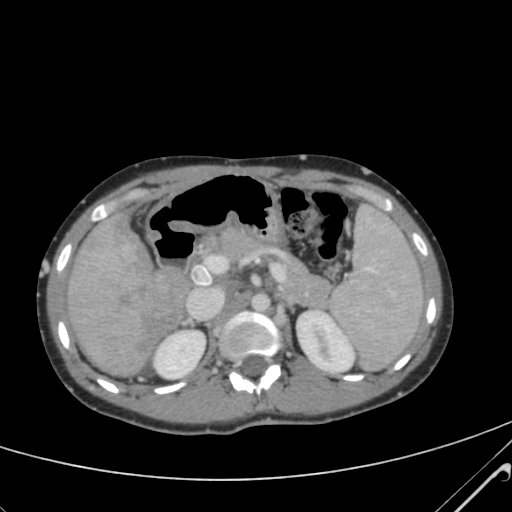 File:Nutmeg liver- Budd-Chiari syndrome (Radiopaedia 46234-50635 B 21).png