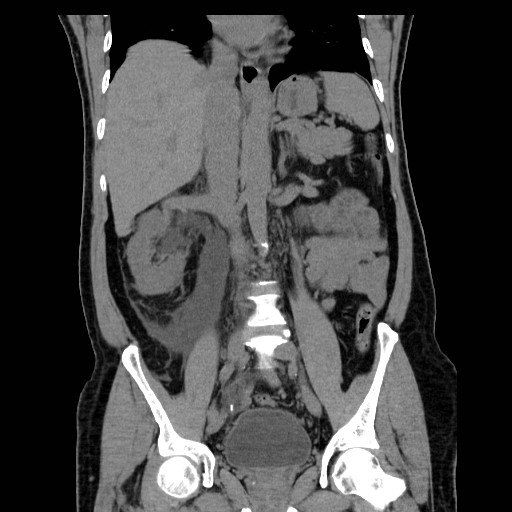 File:Obstructed kidney with perinephric urinoma (Radiopaedia 26889-27066 Coronal non-contrast 1).jpg