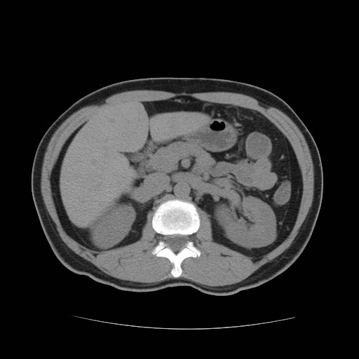 File:Obstructed kidney with perinephric urinoma (Radiopaedia 26889-27067 Axial non-contrast 6).jpg