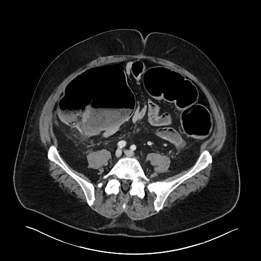 Obstructing sigmoid adenocarcinoma (Radiopaedia 58465-65619 A 112).jpg