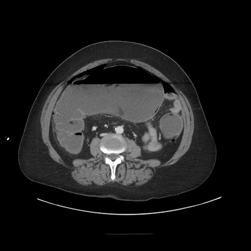 Obstructive distal colonic adenocarcinoma causing cecal perforation (Radiopaedia 86830-102989 A 112).jpg