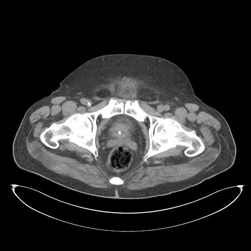 File:Obstructive pyelonephritis (Radiopaedia 46411-50844 Axial non-contrast 76).png