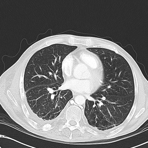 File:Obstructive superior vena cava tumor thrombus (Radiopaedia 28046-28306 Axial lung window 32).jpg