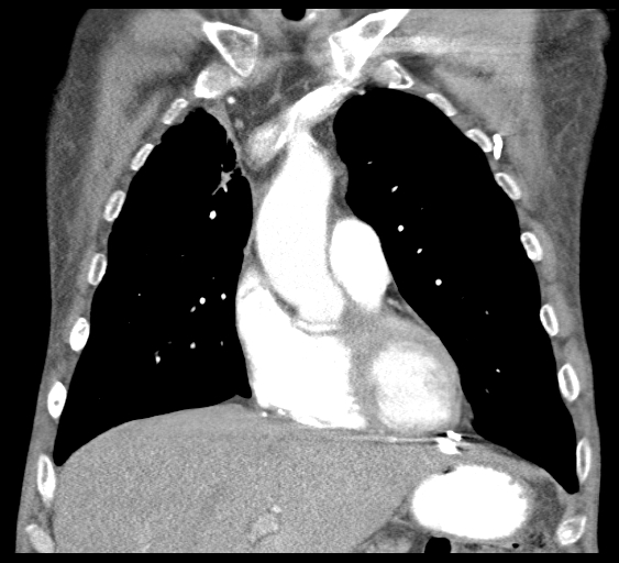 File:Obstructive superior vena cava tumor thrombus (Radiopaedia 28046-28306 B 17).jpg