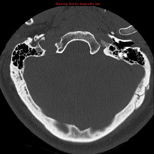 File:Occipital condyle fracture (Radiopaedia 18366-18208 Axial bone window 3).jpg