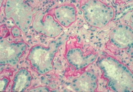 Histology of nephronophthisis, cross-section of kidney showing diffuse interstitial fibrosis