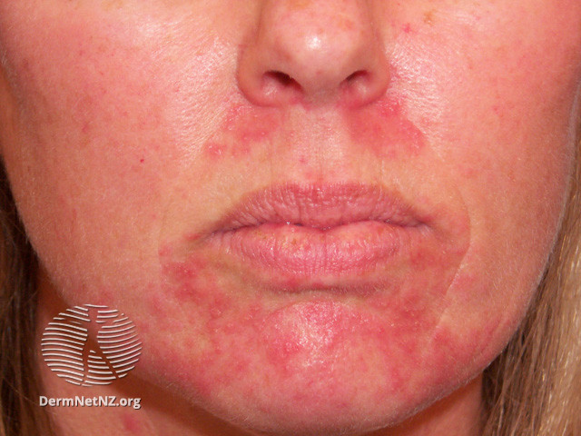 File:Perioral dermatitis (DermNet NZ acne-perioral-dermatitis-3413).jpg