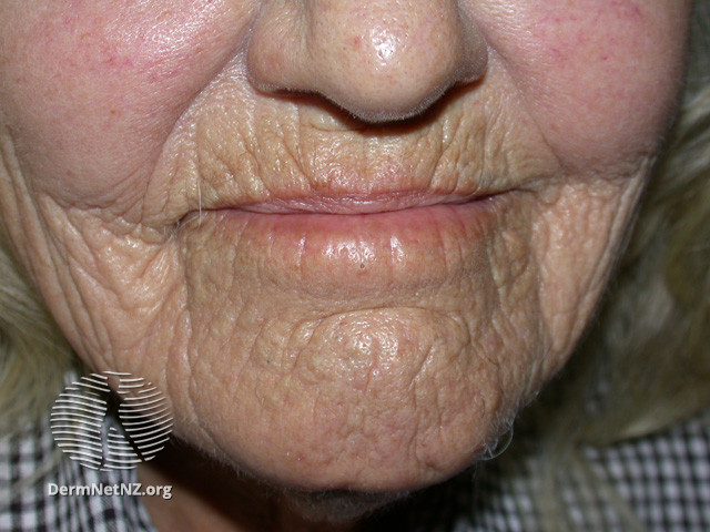 File:Smoking and its effects on the skin (DermNet NZ reactions-smoker-lines3).jpg