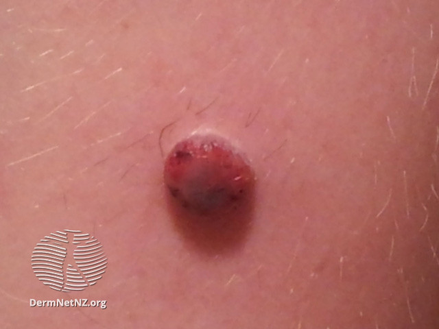 File:Spitzoid melanoma in 10 year old (DermNet NZ lesions-spitzoid-melanoma-1).jpg