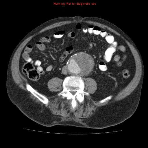File:Abdominal aortic aneurysm (Radiopaedia 10122-10660 Axial C+ portal venous phase 48).jpg