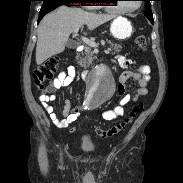 File:Abdominal aortic aneurysm (Radiopaedia 10122-10660 Coronal C+ portal venous phase 12).jpg