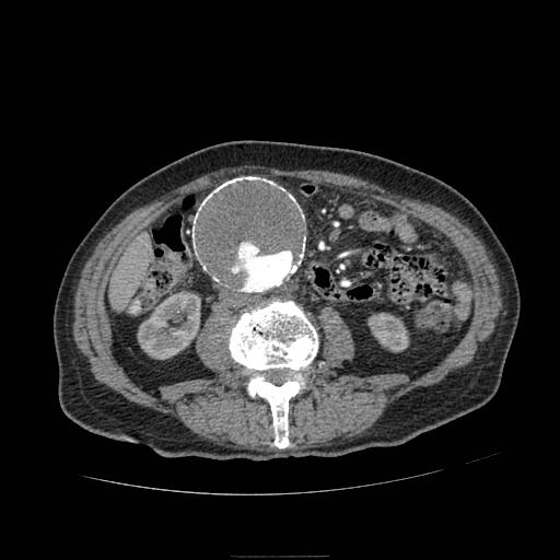 Abdominal aortic aneurysm (Radiopaedia 13341-13340 Axial C+ arterial phase 108).jpg