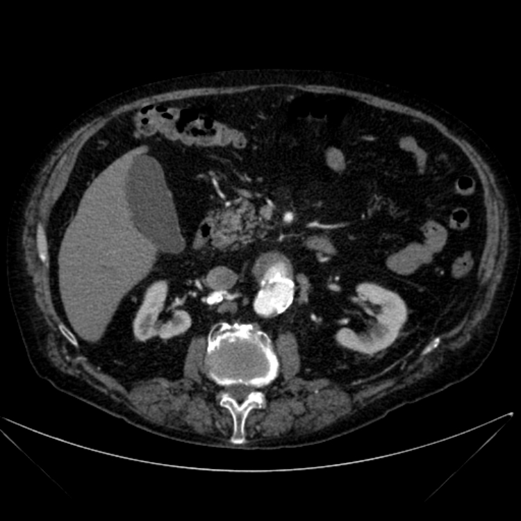 Abdominal aortic aneurysm (Radiopaedia 25855-26001 Axial C+ arterial phase 54).jpg