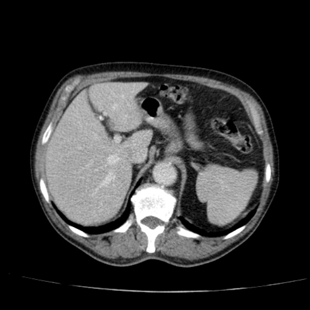 Abdominal aortic aneurysm (Radiopaedia 29248-29660 Axial C+ portal venous phase 15).jpg