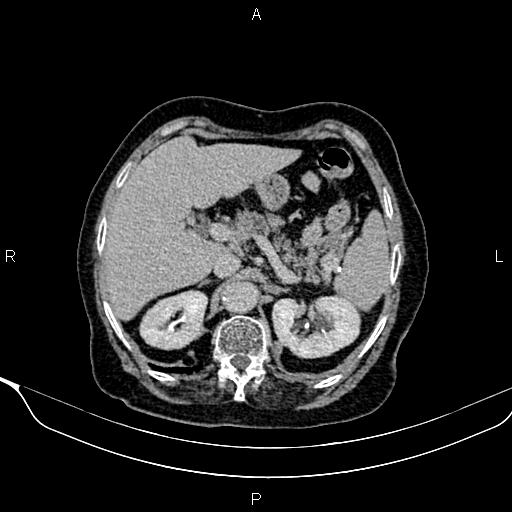 Abdominal aortic aneurysm (Radiopaedia 85063-100606 Axial C+ delayed 20).jpg