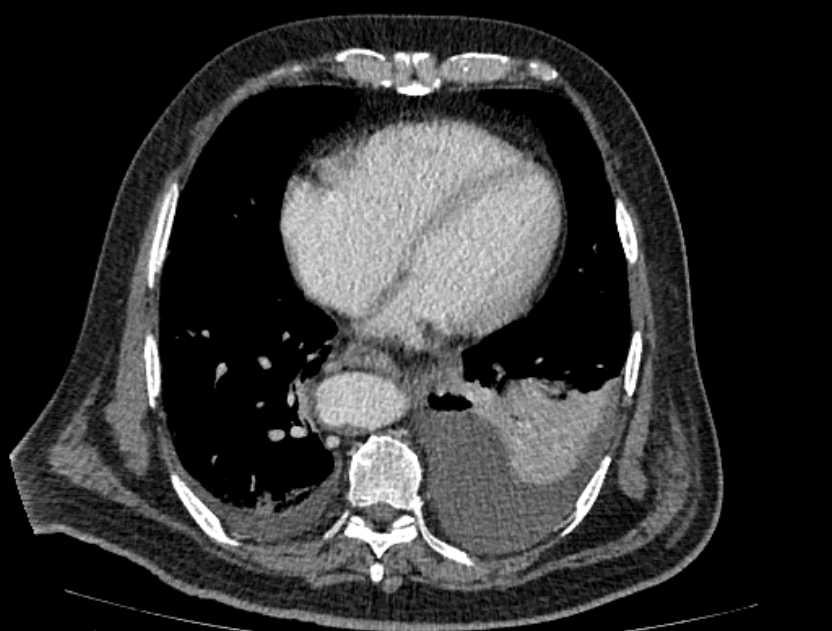 Abdominal aortic aneurysm rupture (Radiopaedia 54179-60362 Axial C+ portal venous phase 38).jpg