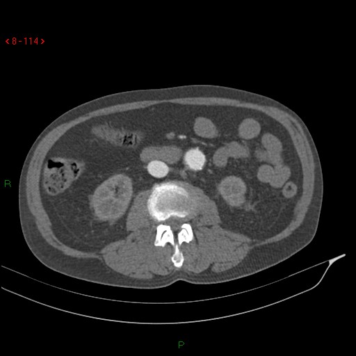 Abdominal aortic aneurysm rupture with aortocaval fistula (Radiopaedia 14897-14841 Axial C+ arterial phase 114).jpg