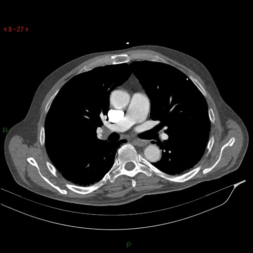 File:Abdominal aortic aneurysm rupture with aortocaval fistula (Radiopaedia 14897-14841 Axial C+ arterial phase 27).jpg