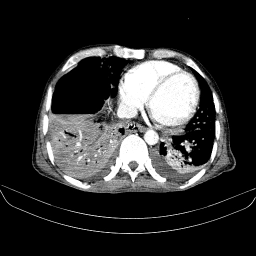 File:Abdominal collection due to previous cecal perforation (Radiopaedia 80831-94320 Axial C+ portal venous phase 8).jpg