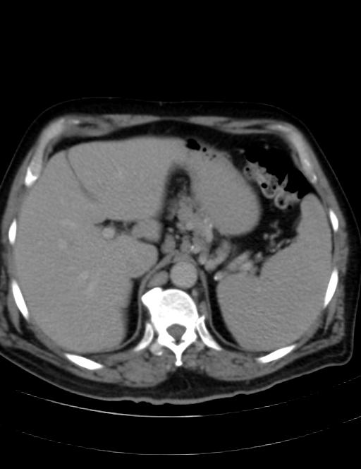 Abdominal lymphoma - with sandwich sign (Radiopaedia 53486-59492 Axial C+ portal venous phase 11).jpg