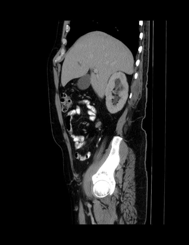 Abdominal lymphoma - with sandwich sign (Radiopaedia 53486-59492 Sagittal C+ portal venous phase 58).jpg