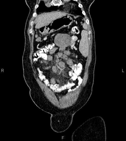 File:Abdominal lymphoma with sandwich sign (Radiopaedia 84378-99704 Coronal C+ portal venous phase 5).jpg