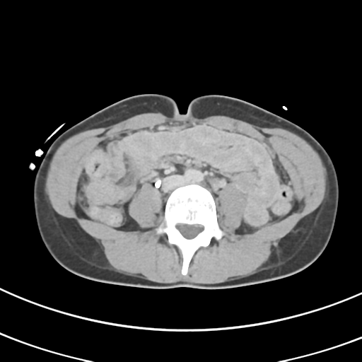 File:Abdominal multi-trauma - devascularised kidney and liver, spleen and pancreatic lacerations (Radiopaedia 34984-36486 Axial C+ delayed 46).png