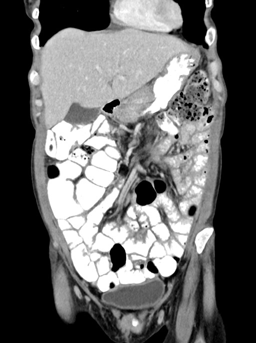 Abdominal wall and retroperitoneal tuberculosis (Radiopaedia 88137-104729 Coronal C+ portal venous phase 28).jpg