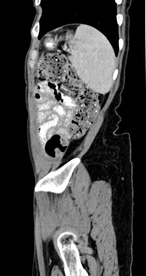 Abdominal wall and retroperitoneal tuberculosis (Radiopaedia 88137-104729 Sagittal C+ portal venous phase 28).jpg
