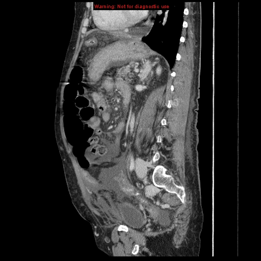 File:Abdominal wall hematoma (Radiopaedia 9427-10112 Sagittal C+ portal venous phase 41).jpg